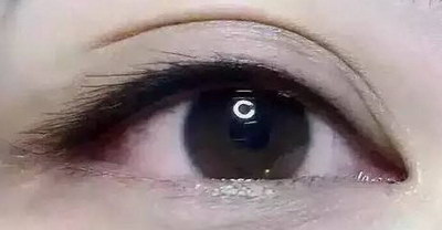 女的眼皮松弛下垂怎么办(一只眼皮松弛下垂怎么办)