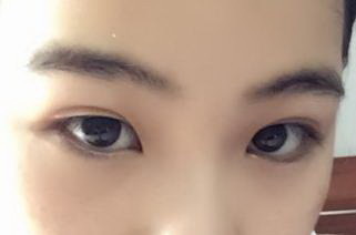 开完眼角会不会眼角变圆[开完眼角会不会变双眼皮]