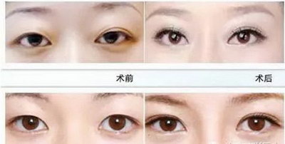 眼部整形费用大概多少啊_做眼部整形大概需要费用