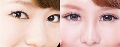 去除眼部汗管瘤的偏方_如何保养眼部不容易长皱纹