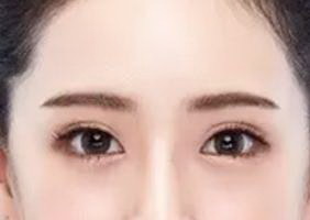 双眼皮开眼角术后多久能健身(手术后的恢复期)