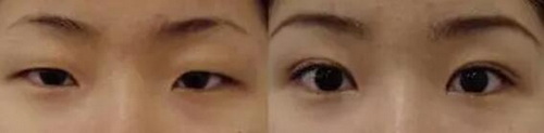 一觉醒来单眼皮变双眼皮_一觉醒来单眼皮变成双眼皮