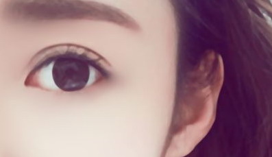 埋线双眼皮后可以用力眯眼吗(埋线双眼皮做完可以用力睁眼吗)