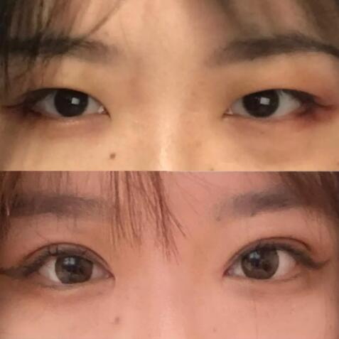 割双眼皮后眼皮肿胀期一般是多久(割双眼皮后眼皮肿胀期一般是多久)