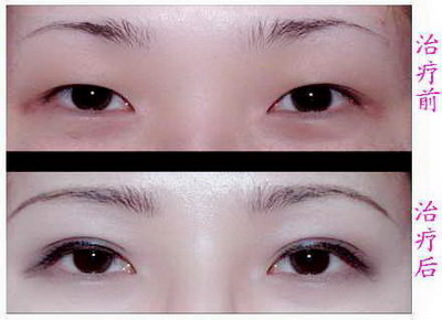 割双眼皮用什么消毒比较好[割双眼皮用什么消毒]
