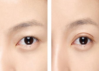 双眼皮拆线后几天可以用美皮护(双眼皮拆线几天可以用美皮护)
