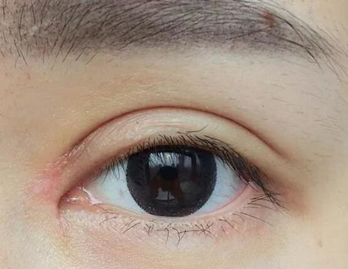 割双眼皮了吃什么恢复快(割双眼皮恢复期忌什么)