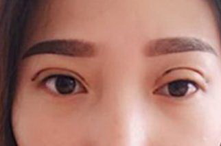 做完埋线双眼皮怎么消肿最快吃什么药(埋线双眼皮术后消肿更快的方法和药品推荐)