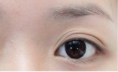 双眼皮一个月后需要注意什么(割完双眼皮一个月后需要注意什么)