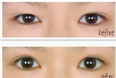 开眼角的费用是多少