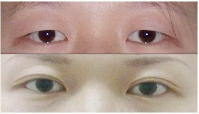 孕期眼部长斑怎么办_如何缓解眼部皱纹