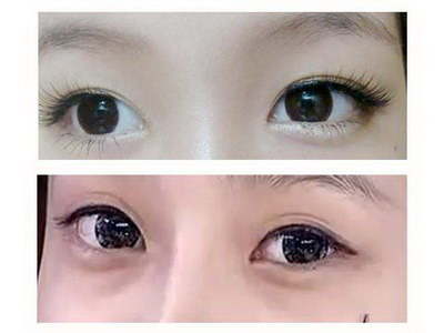眼部美容仪哪个好_眼部细纹怎么造成的