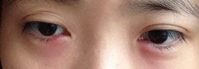苏州眼睑下垂怎么办(眼睑下垂的症状与原因)