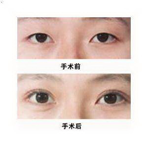 眼睛肿了怎么快速恢复(怎样快速恢复眼睛肿胀？)