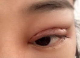 眼睛肿了双眼皮没了怎么恢复_眼睛哭肿了双眼皮没了怎么恢复