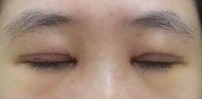 眼袋什么原因造成的_眼袋肌肉松弛怎么办