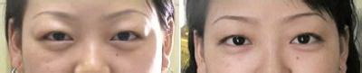 如何简单有效去眼袋