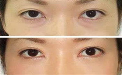 怎么消女性眼袋_怎样除眼袋皱纹