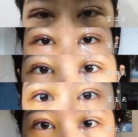 眼部吸脂手术对比照