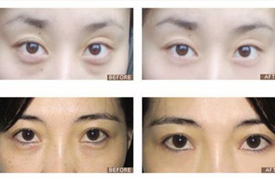 哪里可以做双眼皮松单术「重庆哪里可以做双眼皮」