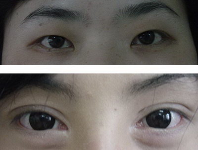韩式双眼皮欧式双眼皮