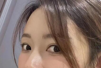眼袋手术后眼屎多怎么办[眼袋手术后脸上紫色淤血怎么办]