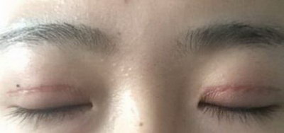 内双埋线双眼皮能维持几年(埋线双眼皮和割能维持几年)