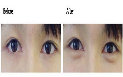 眼角失败能修复吗(眼角开的失败还可以修复吗)