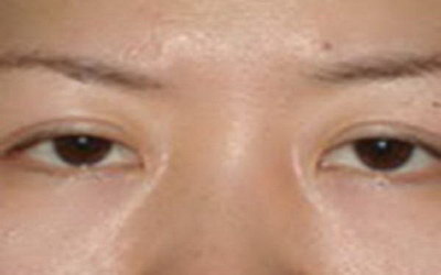 做眼袋手术哪里好啊(想做眼袋手术去哪里做比较好)
