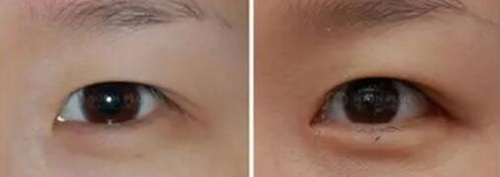 下睑回春术修复失败眼袋(下睑回春术修复失败眼袋)