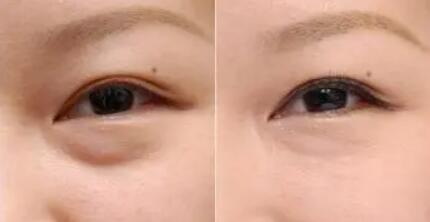 怎么变双眼皮不用双眼皮贴(不用拆线的双眼皮怎么拆)