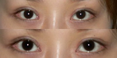 多大年龄才可以割双眼皮呢？