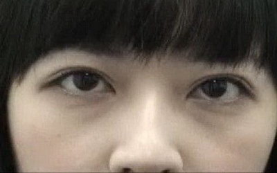 双眼皮不开刀最新技术【最新技术不开刀双眼皮是真的吗】