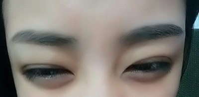 14岁有眼袋怎么回事