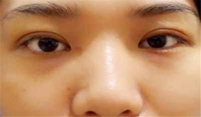 怎样消除肿眼泡上眼皮_做上眼皮提拉手术有没有什么风险
