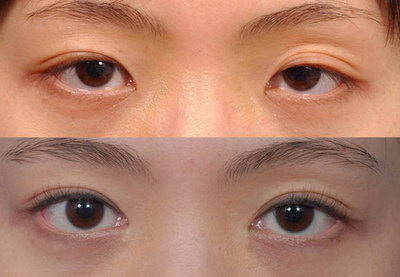 做完双眼皮第六天可以练瑜伽吗[做了双眼皮第六天可以护肤吗]