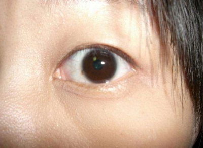 割双眼皮手术后预防感染的方法