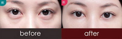 整眼袋要多少钱