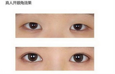 双眼皮和开眼角可以分开做吗(开眼角和双眼皮手术可以分开吗)