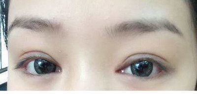 怎么一夜变成双眼皮