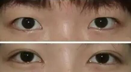 做完双眼皮红肿瘀紫怎么办(双眼皮手术后红肿瘀紫怎么办)