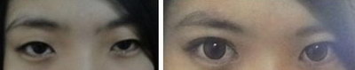 天生黑眼圈怎么去掉的