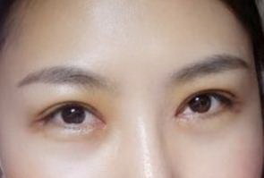 开眼角手术可以用医保卡么(什么是开眼角手术？)