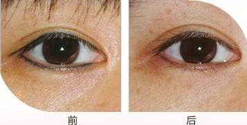 常年累计的黑眼圈怎么去除(常年累计的黑眼圈怎么去除)