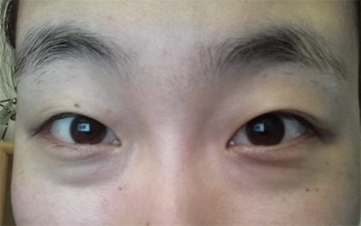 什么是韩式双眼皮