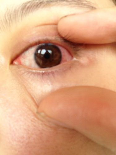 开眼角手术的效果(开眼角手术效果图)