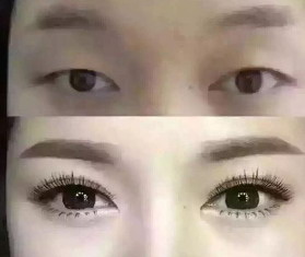 去除眼部汗管瘤的药_祛眼部皱纹的擦眼霜正确手法