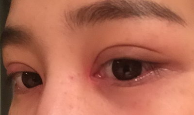 上睑下垂术后眼睛一大一小(上睑下垂术后眼睛闭不上怎么办)