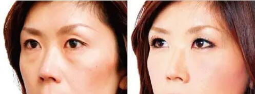 物理定位双眼皮有效吗(物理定位双眼皮效果)