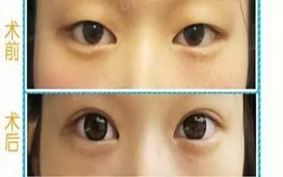 怎么才能长出眼袋「眼袋怎么才能快速的下去」